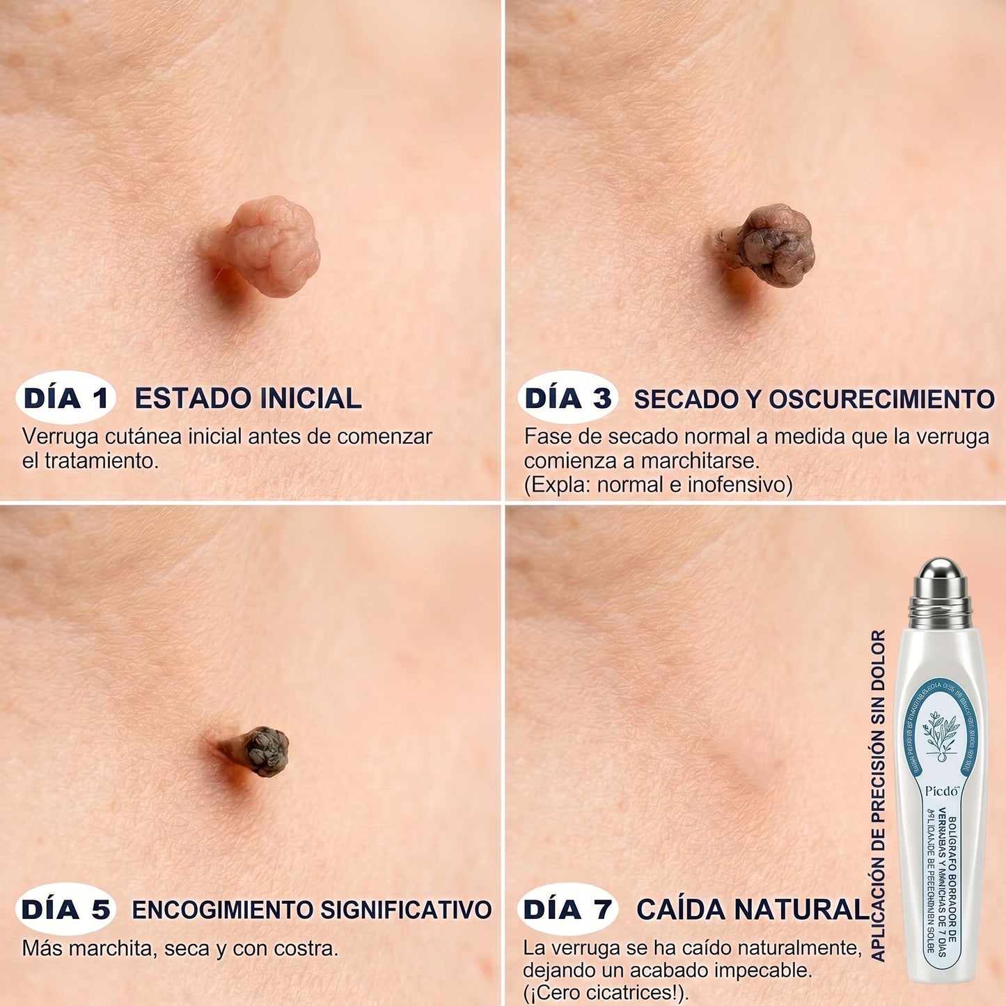 𝐏𝐢𝐜𝐝𝐨® 🌲🌲 Borrador de Verrugas y Manchas en 7 Días (𝐀𝐩𝐥𝐢𝐜𝐚𝐝𝐨𝐫 𝐫𝐨𝐥𝐥-𝐨𝐧: 𝐬𝐢𝐧 𝐝𝐨𝐥𝐨𝐫 𝐧𝐢 𝐜𝐢𝐜𝐚𝐭𝐫𝐢𝐜𝐞𝐬)✨