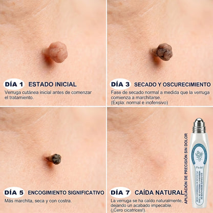 𝐏𝐢𝐜𝐝𝐨® 🌲🌲 Borrador de Verrugas y Manchas en 7 Días (𝐀𝐩𝐥𝐢𝐜𝐚𝐝𝐨𝐫 𝐫𝐨𝐥𝐥-𝐨𝐧: 𝐬𝐢𝐧 𝐝𝐨𝐥𝐨𝐫 𝐧𝐢 𝐜𝐢𝐜𝐚𝐭𝐫𝐢𝐜𝐞𝐬)✨