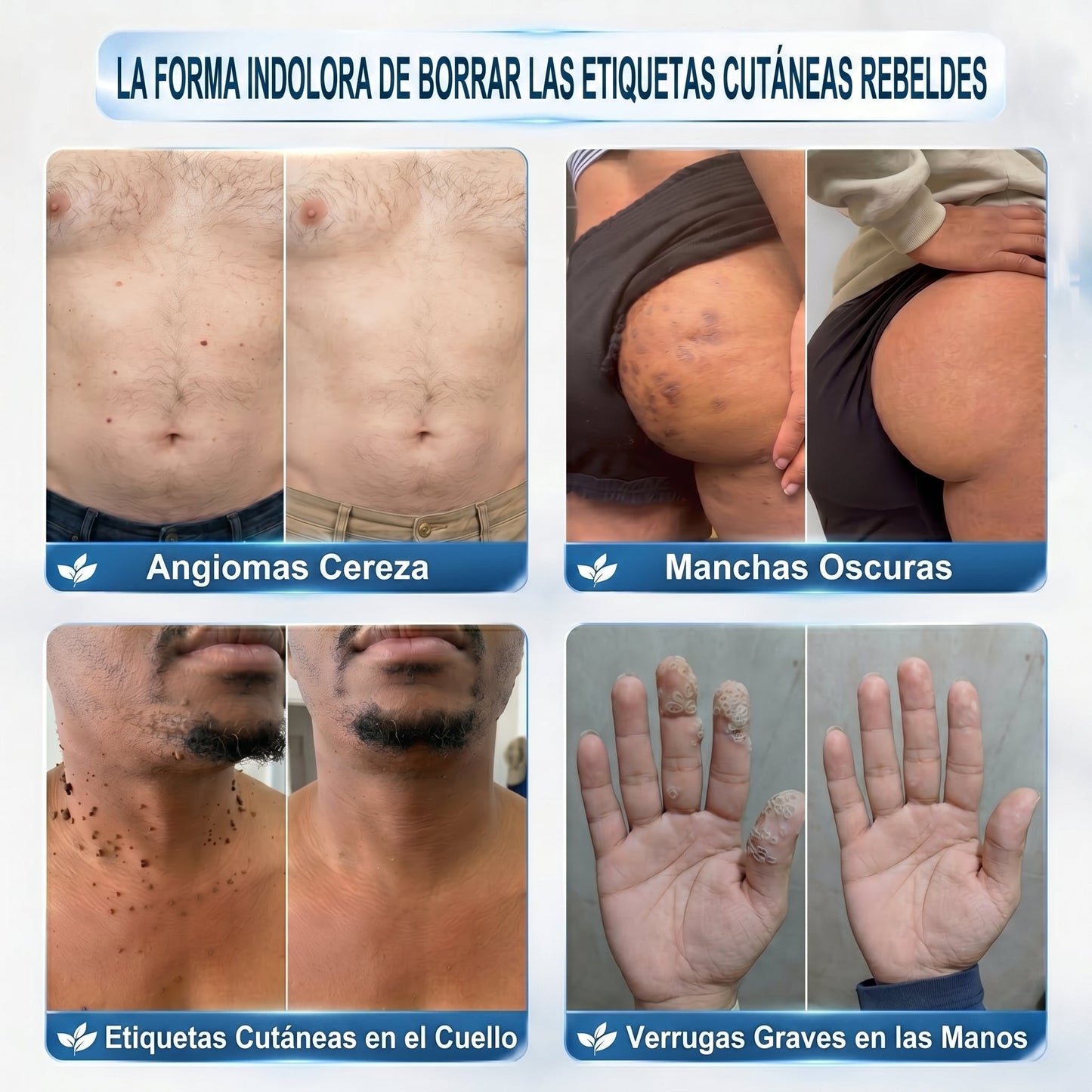 𝐏𝐢𝐜𝐝𝐨® 🌲🌲 Borrador de Verrugas y Manchas en 7 Días (𝐀𝐩𝐥𝐢𝐜𝐚𝐝𝐨𝐫 𝐫𝐨𝐥𝐥-𝐨𝐧: 𝐬𝐢𝐧 𝐝𝐨𝐥𝐨𝐫 𝐧𝐢 𝐜𝐢𝐜𝐚𝐭𝐫𝐢𝐜𝐞𝐬)✨